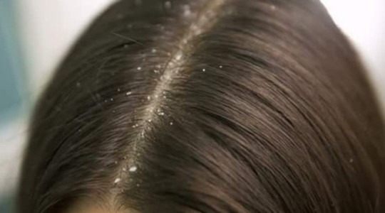 Kepek Nasıl Geçer?