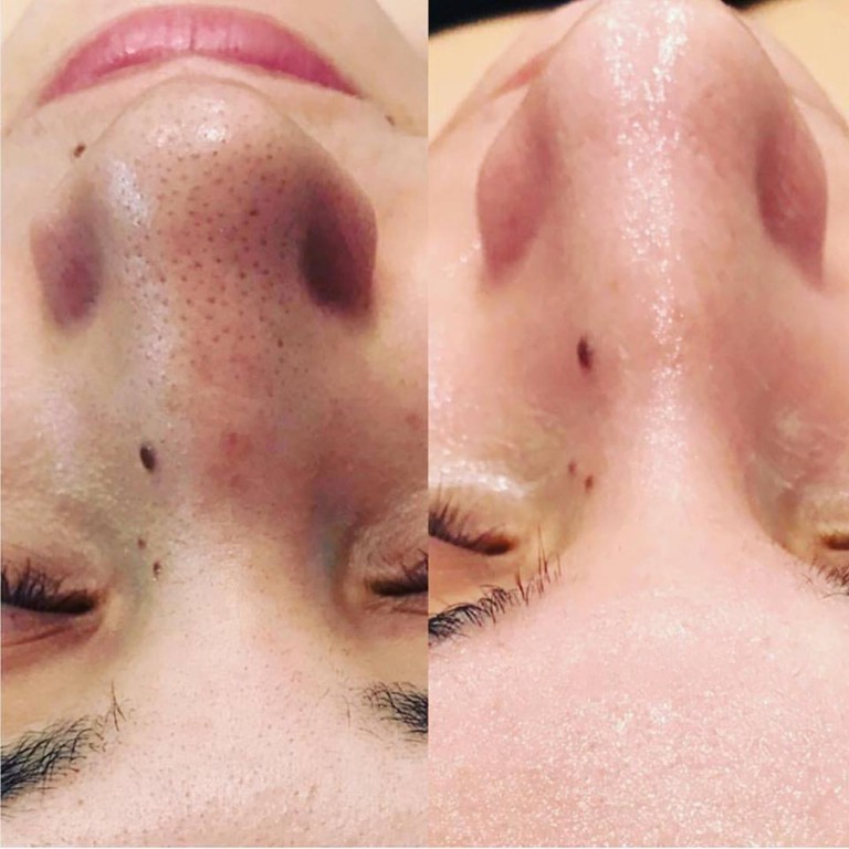 Siyah Nokta Nasil Gecer